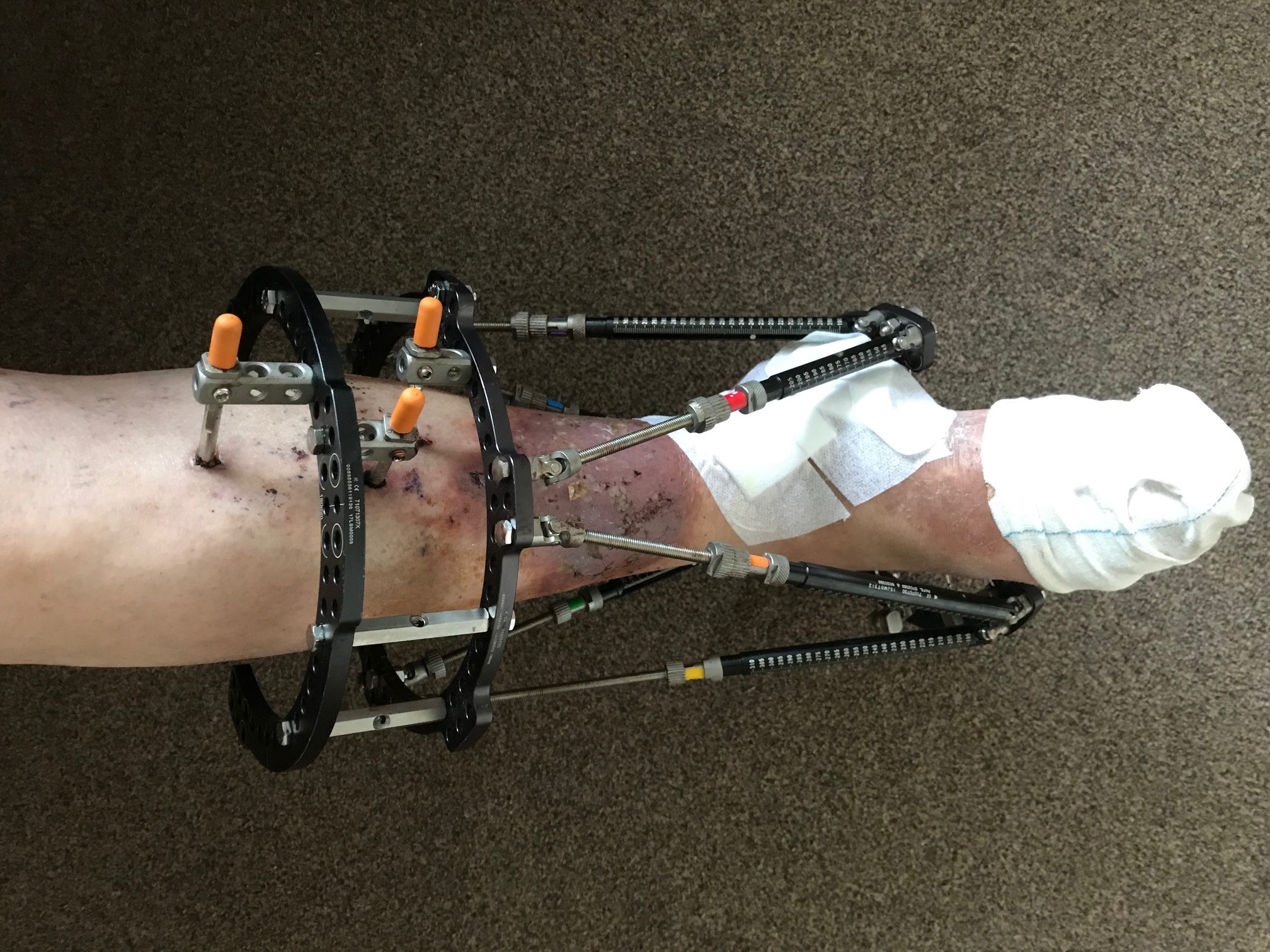 Ian's foot and lower leg. There are bandages on his foot. His lower leg is bruised and in a frame - pins go in his leg.