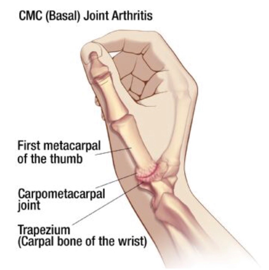 Hand Therapy - Carpometacarpal Joint Osteoarthritis - North Tees and ...