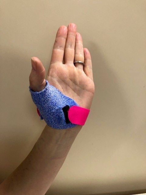 Image of hand in splint.