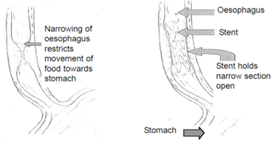 upper organs and and narrowing of oesophagus.