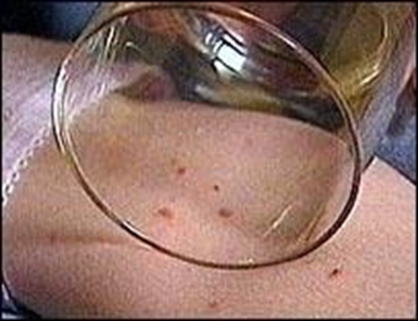 A glass pressing against a rash.