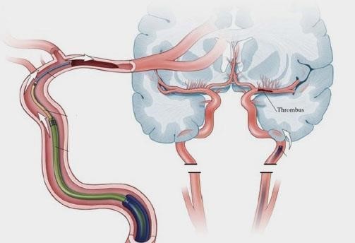 blood clot ‘thrombus’ causing the stroke, and the guide wire going up the vessel to reach and remove the clot.