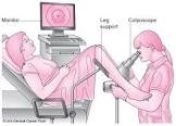 viewing cervix