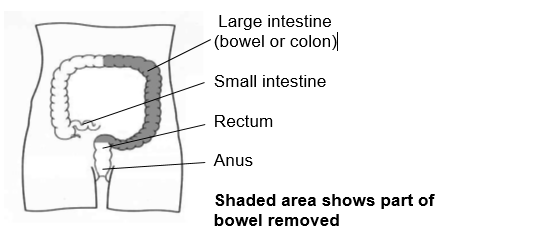 Shaded area shows part of the bowel removed