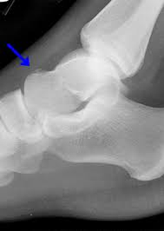 Sample X-ray images of avulsion fracture