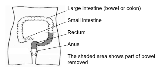 Shaded area shows part of the bowel removed