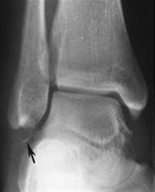 Sample X-ray images of avulsion fracture