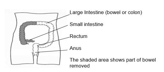 Shaded area shows part of the bowel removed