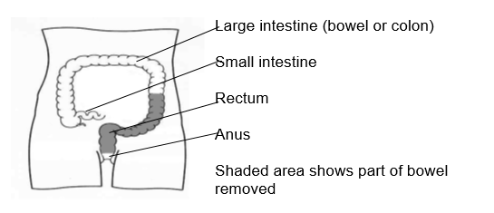 Shaded area shows part of the bowel removed