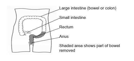 Shaded area shows part of the bowel removed