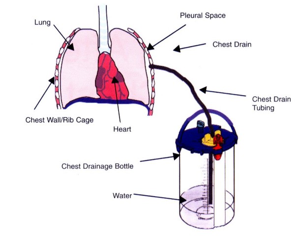 A liquid container connected to the lung with a tube.