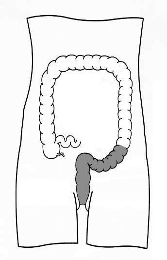 shaded area shows part of bowel examined.