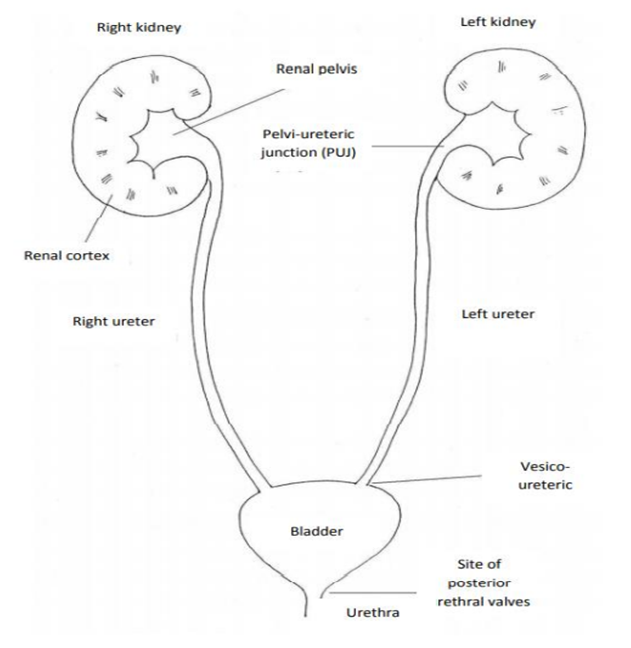 renal pelvic dilatarion