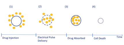 Concept of ePORE Therapy: (1) Calcium injection surrounds tumour cell. (2) Electrical pulses are applied and this leads to pore formation in tumour cells and calcium entry into the cell. (3) Calcium is absorbed by the tumour cell as the pores close. (4) Calcium kills the cancer cells.