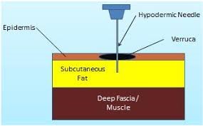 process of dry needling