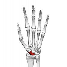 scaphoid fracture