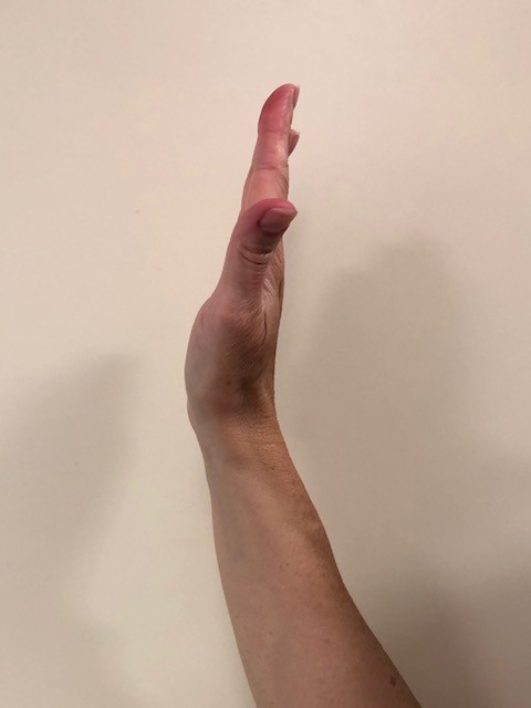 Hand injury exercise 9: Passive finger hook fist 