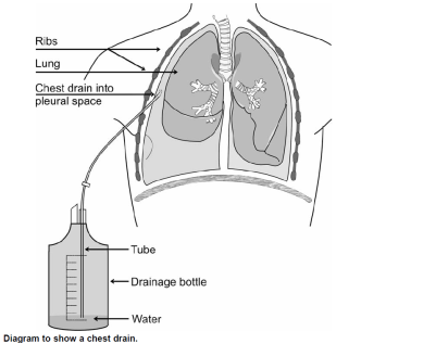 Diagram of lung with chest drain inserted into the pleural space.