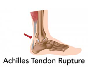 an Achilles tendon rupture