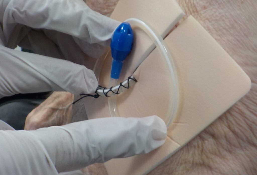Image showing a catheter in place.