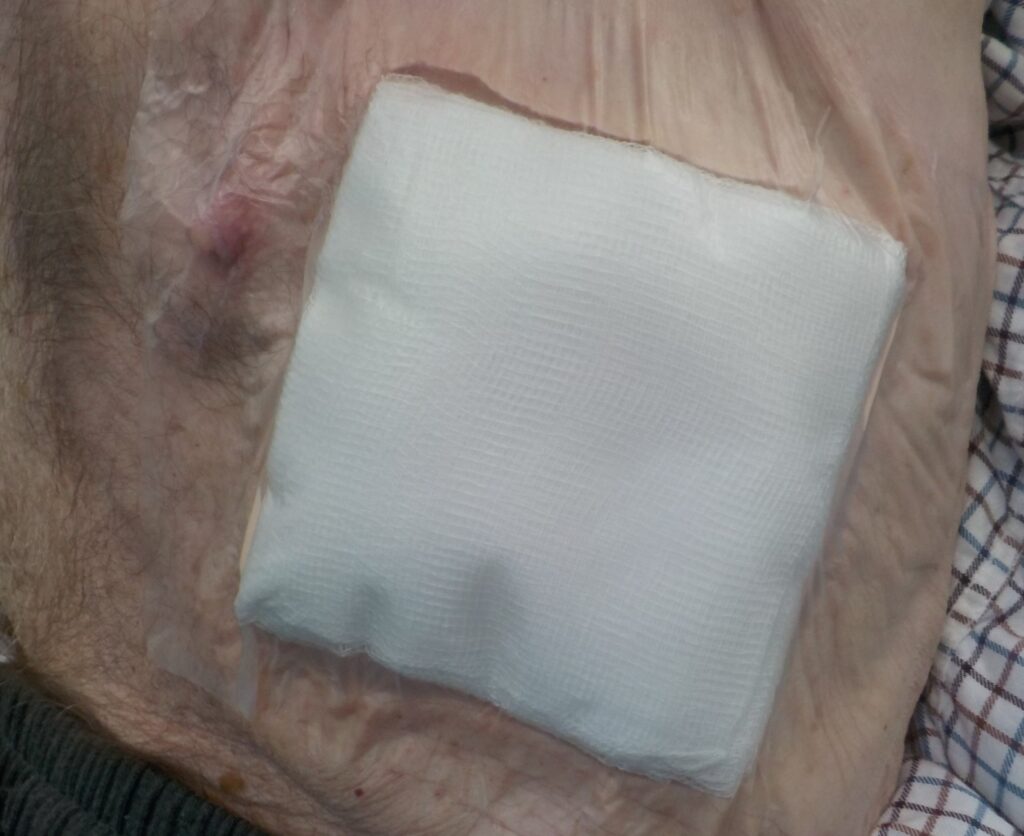 Image showing a covered up catheter cut with gauze.