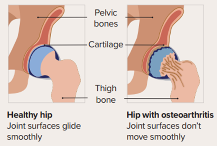 a healthy hip on the left compared with a hip with osteoarthritis on the right.