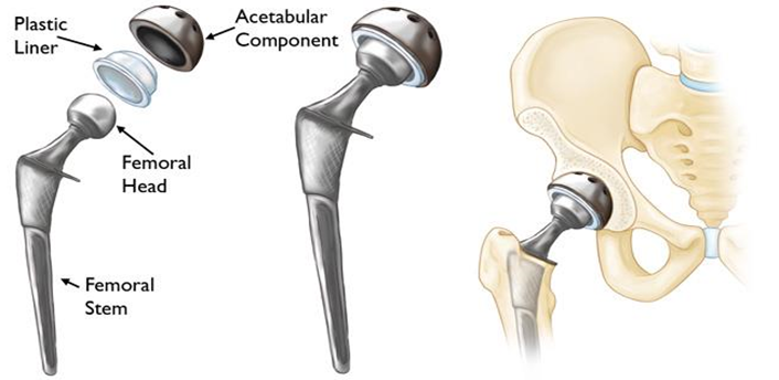 a hip replacement and how it fits into the pelvis.