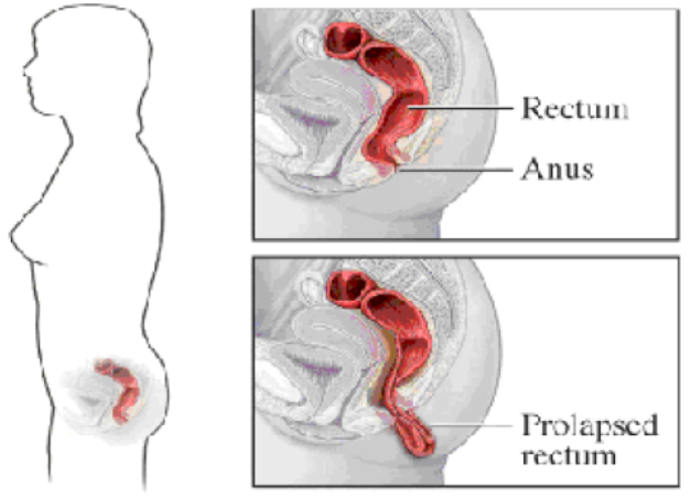 Picture of a normal rectum and anus along with a picture of a prolapsed rectum.