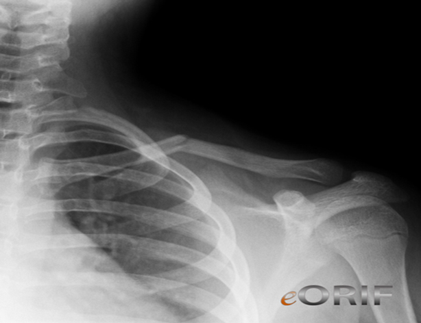 an x-ray of a clavicle fracture.