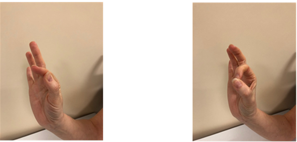 Hand Therapy Exercises Following Trapeziectomy North Tees And Hand Therapy Exercises Following Trapeziectomy North Tees And