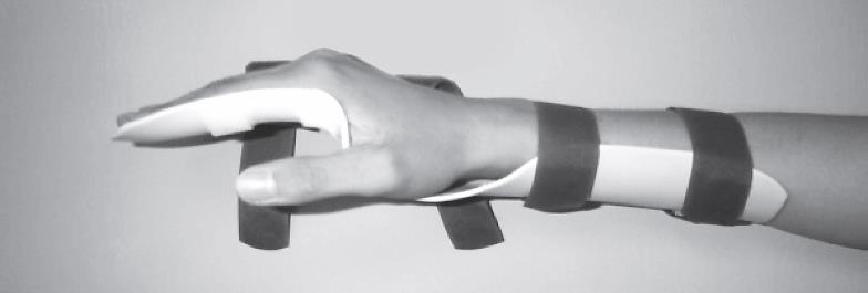 Example of hand in splint