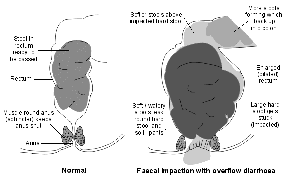 Image of constipation in the bowel.