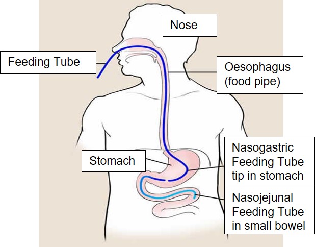 This shows the internal position of both a nasogastric and nasojejunal feeding tube