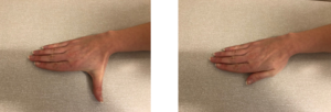 Hand Therapy - Exercise Following Flexor Pollicis Longus (FPL) Repair ...