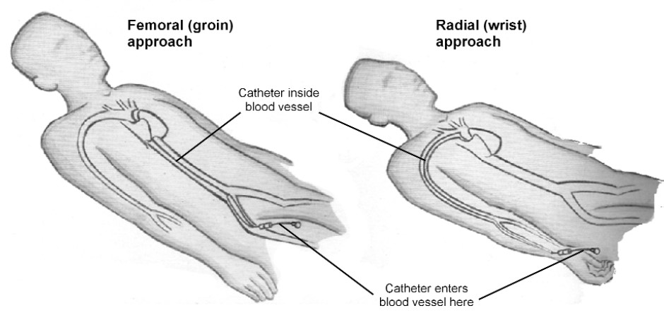 shows where the catheter goes into the body and how it reaches the heart.