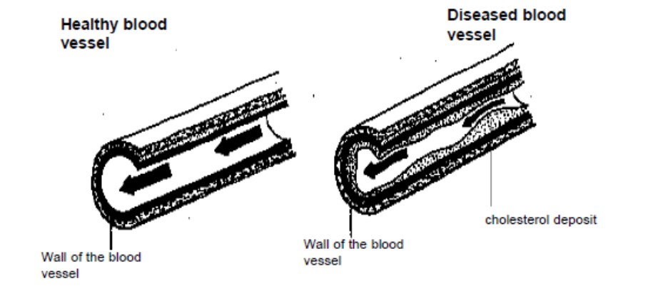 shows a healthy and a diseased blood vessel.