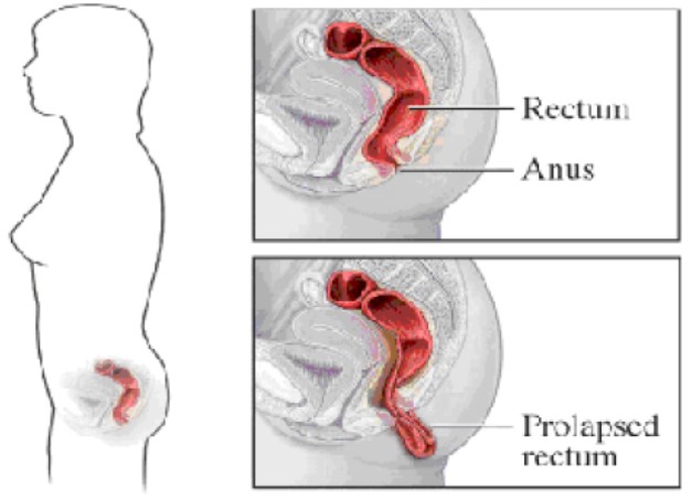 Prolapsed anus and the surrounding area.