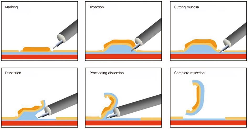 Pictures of the process for removing the colorectal growths.