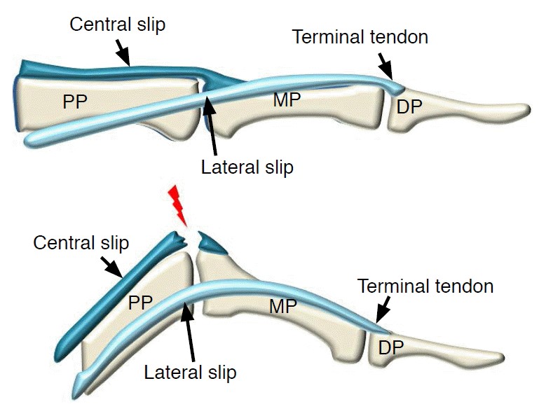 Picture showcasing the central slip and how it gets injured