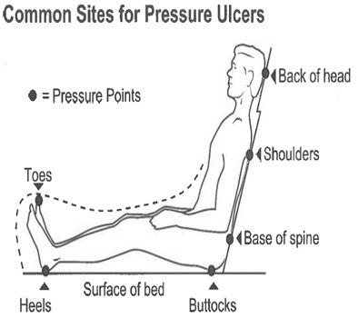common sites for pressure ulcers
