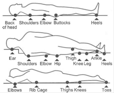 common sites for pressure ulcers