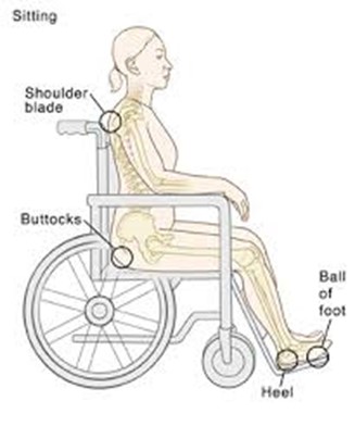 common sites for pressure ulcers