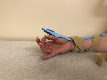 Hand with a splint