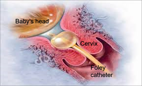 showing the catheter being inserted and inflated in the cervix.