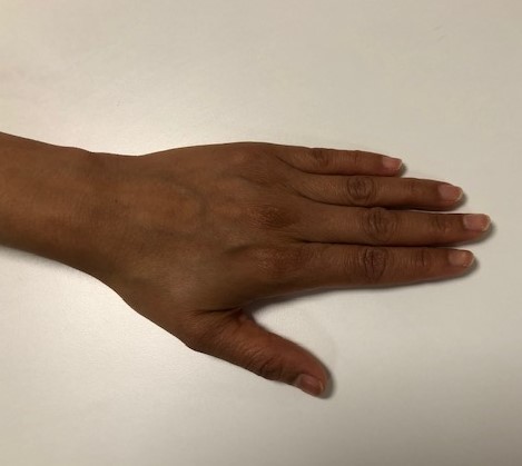 First part of the Active Thumb Extension exercise.
