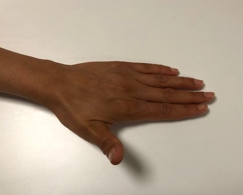 Second part of the Active Thumb Extension exercise.