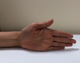 Second part of the Active Thumb Abduction exercise.