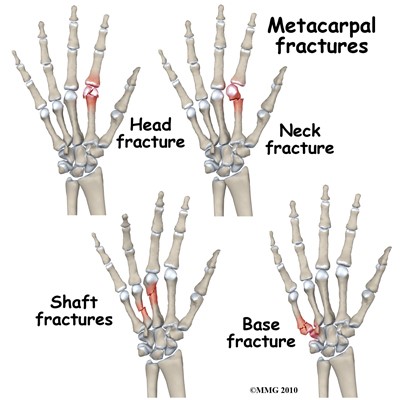 Metacarpal bones per finger on your hand