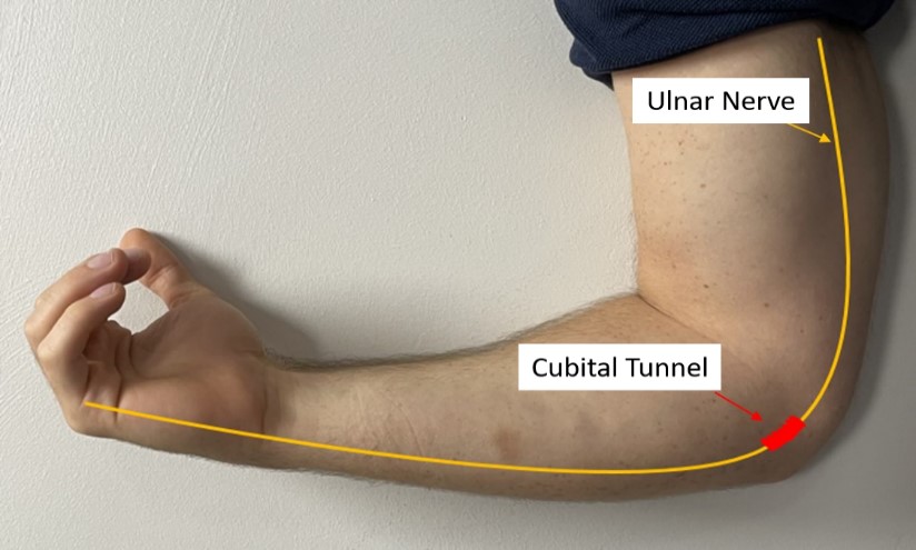 Image showcasing the nerve where Cubital Tunnel occurs.