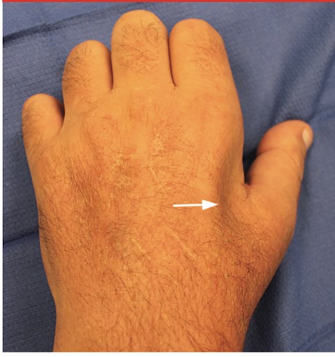 Image showcasing muscle loss in between the thumb and first finger.